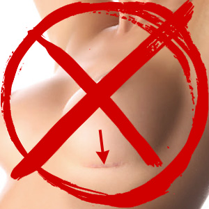 Augmentation mammaire sans cicatrice